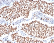 IHC staining of FFPE human seminoma tissue with OCT4 antibody (clone OCT4/6847R). HIER: boil tissue sections in pH 9 10mM Tris with 1mM EDTA for 20 min and allow to cool before testing.