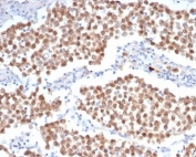 IHC staining of FFPE human seminoma tissue with OCT4 antibody (clone OCT4/6847R). HIER: boil tissue sections in pH 9 10mM Tris with 1mM EDTA for 20 min and allow to cool before testing.