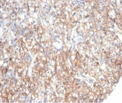 IHC staining of FFPE human kidney carcinoma with Fibrillin 1 antibody (clone FBN1/6933). HIER: boil tissue sections in pH 9 10mM Tris with 1mM EDTA for 20 min and allow to cool before testing.
