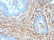 IHC staining of FFPE human colon carcinoma with Fibrillin 1 antibody (clone FBN1/6933). HIER: boil tissue sections in pH 9 10mM Tris with 1mM EDTA for 20 min and allow to cool before testing.
