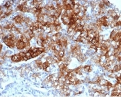 IHC staining of FFPE human kidney carcinoma tissue with CD13 antibody (clone APN/6997) at 2ug/ml. HIER: boil tissue sections in pH 9 10mM Tris with 1mM EDTA for 20 min and allow to cool before testing.
