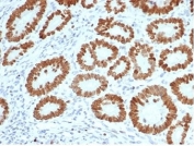 IHC staining of FFPE human colon tissue with SATB2 antibody (clone SATB2/7111). HIER: boil tissue sections in pH 9 10mM Tris with 1mM EDTA for 20 min and allow to cool before testing.