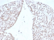 IHC staining of FFPE human renal oncocytoma with recombinant Steroidogenic Factor 1 antibody (clone rNR5A1/4369). HIER: boil tissue sections in pH 9 10mM Tris with 1mM EDTA for 20 min and allow to cool before testing.