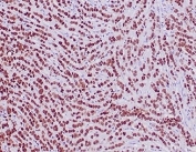 IHC staining of FFPE human lobular breast carcinoma tissue with recombinant GATA Binding Protein 3 antibody (clone rGATA3/3870). HIER: boil tissue sections in pH 9 10mM Tris with 1mM EDTA for 20 min and allow to cool before testing.