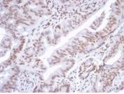 IHC staining of FFPE human colon tissue with ATRX antibody (clone ATRX/7188R). HIER: boil tissue sections in pH 9 10mM Tris with 1mM EDTA for 20 min and allow to cool before testing.