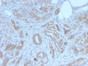 IHC staining of FFPE human breast carcinoma tissue with GLG1 antibody (clone GLG1/7174R).