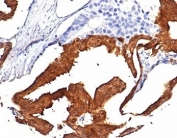 IHC staining of FFPE human prostate tissue with IDH1-R132H mutation with Isocitrate Dehydrogenase R132H Mutant antibody (clone IDH1/7277R). HIER: boil tissue sections in pH 9 10mM Tris with 1mM EDTA for 20 min and allow to cool before testing.