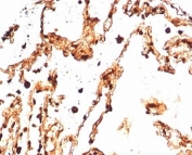 IHC staining of FFPE human lung tissue with S100A4 antibody (clone S100A4/7096). HIER: boil tissue sections in pH 9 10mM Tris with 1mM EDTA for 20 min and allow to cool before testing.
