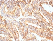 IHC staining of FFPE human colon carcinoma tissue with recombinant EpCAM antibody (clone rEGP40/7133). HIER: boil tissue sections in pH 9 10mM Tris with 1mM EDTA for 20 min and allow to cool before testing.