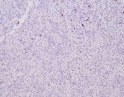 IHC staining of FFPE human glioma tissue with MGMT antibody (clone MGMT/4791). HIER: boil tissue sections in pH 9 10mM Tris with 1mM EDTA for 20 min and allow to cool before testing.