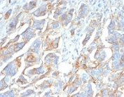 IHC staining of FFPE human ovarian carcinoma tissue with B7-H3 antibody (clone B7H3/4345). HIER: boil tissue sections in pH 9 10mM Tris with 1mM EDTA for 20 min and allow to cool before testing.