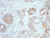 IHC staining of FFPE human ovarian carcinoma tissue with B7-H3 antibody (clone B7H3/4345). HIER: boil tissue sections in pH 9 10mM Tris with 1mM EDTA for 20 min and allow to cool before testing.