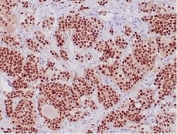 IHC staining of FFPE human pituitary tissue with POU1F1 antibody (clone PIT1/7262). HIER: boil tissue sections in pH 9 10mM Tris with 1mM EDTA for 20 min and allow to cool before testing.