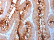 IHC staining of FFPE human colon carcinoma tissue with CEA antibody. HIER: boil tissue sections in pH 9 10mM Tris with 1mM EDTA for 20 min and allow to cool before testing.