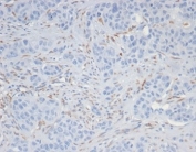 IHC staining of FFPE human kidney cancer tissue with SALL4 antibody (clone SALL4/7301). HIER: boil tissue sections in pH 9 10mM Tris with 1mM EDTA for 20 min and allow to cool before testing.