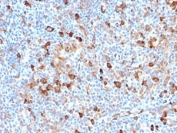 IHC staining of FFPE human Hodgkin's lymphoma with FSCN1 antibody (clone FSCN1/7209). HIER: boil tissue sections in pH 9 10mM Tris with 1mM EDTA for 20 min and allow to cool before testing.