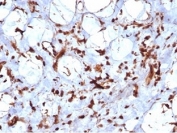 IHC staining of FFPE human liposarcoma tissue with recombinant STAT6 antibody (clone STAT6/7163R). HIER: boil tissue sections in pH 9 10mM Tris with 1mM EDTA for 20 min and allow to cool before testing.