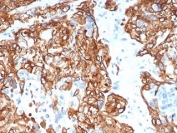 IHC staining of FFPE human lung carcinoma tissue with CK14 antibody (clone KRT14/6957). HIER: boil tissue sections in pH 9 10mM Tris with 1mM EDTA for 20 min and allow to cool before testing.