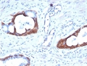 IHC staining of FFPE human prostate carcinoma with Cytokeratin 14 antibody (clone KRT14/4127). HIER: boil tissue sections in pH 9 10mM Tris with 1mM EDTA for 20 min and allow to cool before testing.