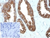 IHC staining of FFPE human prostate carcinoma tissue with recombinant Keratin 8/18 antibody (clone KRT8.18/4997R). Negative control inset: PBS used instead of primary antibody to control for secondary Ab binding. HIER: boil tissue sections in pH 9 10mM Tris with 1mM EDTA for 20 min and allow to cool before testing.
