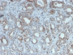 IHC staining of FFPE human breast cancer with Purified RET antibody (clone RET/2975). HIER: boil tissue sections in pH 9 10mM Tris with 1mM EDTA for 20 min and allow to cool before testing.
