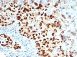 IHC staining of FFPE human lung carcinoma tissue with GATA-3 antibody (clone GATA3/7685R). HIER: boil tissue sections in pH 9 10mM Tris with 1mM EDTA for 20 min and allow to cool before testing.