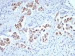 IHC staining of FFPE human breast carinoma tissue with GATA-3 antibody (clone GATA3/7685R). HIER: boil tissue sections in pH 9 10mM Tris with 1mM EDTA for 20 min and allow to cool before testing.