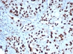 IHC staining of FFPE human bladder tissue with GATA-3 antibody (clone GATA3/7685R). HIER: boil tissue sections in pH 9 10mM Tris with 1mM EDTA for 20 min and allow to cool before testing.