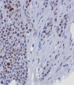 IHC staining of FFPE human breast carinoma tissue with GATA-3 antibody (clone GATA3/8327R). HIER: boil tissue sections in pH 9 10mM Tris with 1mM EDTA for 20 min and allow to cool before testing.