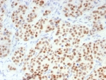 IHC staining of FFPE human breast carinoma tissue with GATA-3 antibody (clone GATA3/7686R). HIER: boil tissue sections in pH 9 10mM Tris with 1mM EDTA for 20 min and allow to cool before testing.