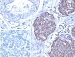IHC staining of FFPE human ovarian cancer tissue with GATA-3 antibody (clone GATA3/7686R). Inset: PBS used in place of primary Ab (secondary Ab negative control). HIER: boil tissue sections in pH 9 10mM Tris with 1mM EDTA for 20 min and allow to cool before testing.