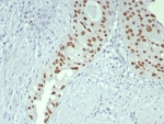 IHC staining of FFPE human bladder tissue with GATA-3 antibody (clone GATA3/7686R). HIER: boil tissue sections in pH 9 10mM Tris with 1mM EDTA for 20 min and allow to cool before testing.