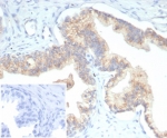 IHC staining of FFPE human prostate carcinoma tissue with PTEN antibody (clone PTEN/7345) at 2ug/ml. Inset: PBS used in place of primary Ab (secondary Ab negative control). HIER: boil tissue sections in pH 9 10mM Tris with 1mM EDTA for 20 min and allow to cool before testing.