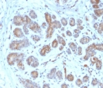 IHC staining of FFPE human breast carinoma tissue with PTEN antibody (clone PTEN/2159). HIER: boil tissue sections in pH 9 10mM Tris with 1mM EDTA for 20 min and allow to cool before testing.