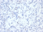 IHC staining of FFPE human renal cell carcinoma tissue with PAX2 antibody (clone PAX2/2994). HIER: boil tissue sections in pH 9 10mM Tris with 1mM EDTA for 20 min and allow to cool before testing.