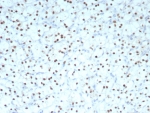 IHC staining of FFPE human renal cell carcinoma tissue with PAX2 antibody (clone PAX2/8671R) at 2ug/ml. HIER: boil tissue sections in pH 9 10mM Tris with 1mM EDTA for 20 min and allow to cool before testing.