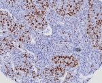 IHC staining of FFPE human lung adenocarcinoma. Ki67 antibody (clone MKI67/8005R). HIER: boil tissue sections in pH 9 10mM Tris with 1mM EDTA for 20 min and allow to cool before testing.