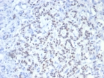 IHC staining of FFPE human pancreatic cancer with PAX6 antibody (clone PAX6/7708). HIER: boil tissue sections in pH 9 10mM Tris with 1mM EDTA for 20 min and allow to cool before testing.