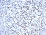 IHC staining of FFPE human pancreatic cancer with PAX6 antibody (clone PAX6/7707). HIER: boil tissue sections in pH 9 10mM Tris with 1mM EDTA for 20 min and allow to cool before testing.