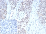 IHC staining of FFPE human ovarian carcinoma tissue with Wilms Tumor antibody (clone WT1/7450). Inset: PBS used in place of primary Ab (secondary Ab negative control). HIER: boil tissue sections in pH 9 10mM Tris with 1mM EDTA for 20 min and allow to cool before testing.