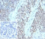 IHC staining of FFPE human ovarian carcinoma tissue with Wilms Tumor 1 antibody (clone WT1/7451). Inset: PBS used in place of primary Ab (secondary Ab negative control). HIER: boil tissue sections in pH 9 10mM Tris with 1mM EDTA for 20 min and allow to cool before testing.