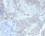 IHC staining of FFPE human ovarian carcinoma tissue with Wilm's Tumor antibody (clone WT1/7452). Inset: PBS used in place of primary Ab (secondary Ab negative control). HIER: boil tissue sections in pH 9 10mM Tris with 1mM EDTA for 20 min and allow to cool before testing.