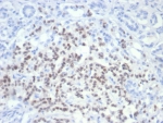 IHC staining of FFPE human pancreatic cancer with PAX6 antibody (clone PAX6/7705). HIER: boil tissue sections in pH 9 10mM Tris with 1mM EDTA for 20 min and allow to cool before testing.