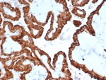 IHC staining of FFPE human kidney cancer with Crystallin Alpha B antibody (clone CRYAB/4665). HIER: boil tissue sections in pH 9 10mM Tris with 1mM EDTA for 20 min and allow to cool before testing.