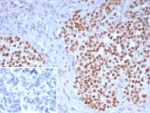 IHC staining of FFPE human ovarian carcinoma tissue with WT1 antibody (clone WT1/7715). Inset: PBS used in place of primary Ab (secondary Ab negative control). HIER: boil tissue sections in pH 9 10mM Tris with 1mM EDTA for 20 min and allow to cool before testing.
