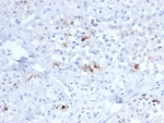 IHC staining of FFPE human pituitary tissue with FSH beta antibody (clone FSHB/6845). HIER: boil tissue sections in pH 9 10mM Tris with 1mM EDTA for 20 min and allow to cool before testing.