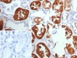 IHC staining of FFPE human kidney cancer with TPH1 antibody (clone TPH1/7661). Inset: PBS used in place of primary Ab (secondary Ab negative control). HIER: boil tissue sections in pH 9 10mM Tris with 1mM EDTA for 20 min and allow to cool before testing.