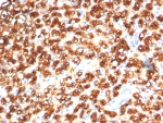 IHC staining of FFPE human kidney cancer with TPH1 antibody (clone TPH1/7662). HIER: boil tissue sections in pH 9 10mM Tris with 1mM EDTA for 20 min and allow to cool before testing.