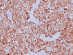 IHC staining of FFPE human medullary carcinoma tissue with Calcitonin antibody (clone CALCA/8639R). HIER: boil tissue sections in pH 9 10mM Tris with 1mM EDTA for 20 min and allow to cool before testing.