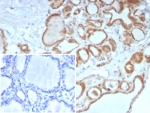 IHC staining of FFPE human thyroid tissue with Calcitonin antibody (clone CALCA/8639R). Inset: PBS used in place of primary Ab (secondary Ab negative control). HIER: boil tissue sections in pH 9 10mM Tris with 1mM EDTA for 20 min and allow to cool before testing.